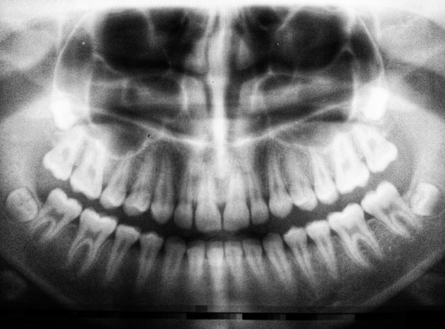 Refaire toutes ses dents en france